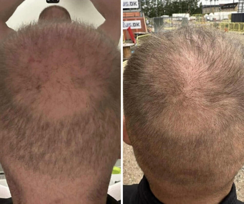 Før og efter Meso Scalp 1