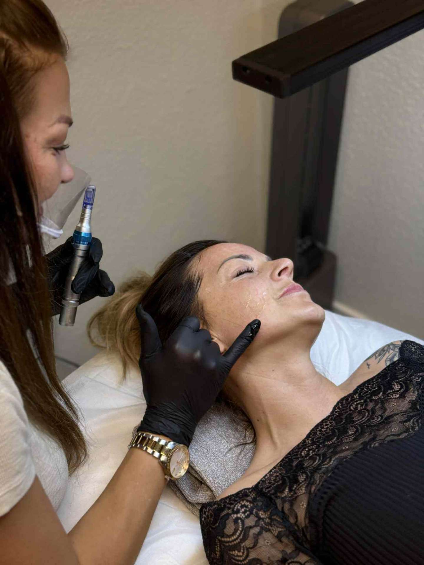 Exosomer + Microneedling – Avanceret Hudforyngelse