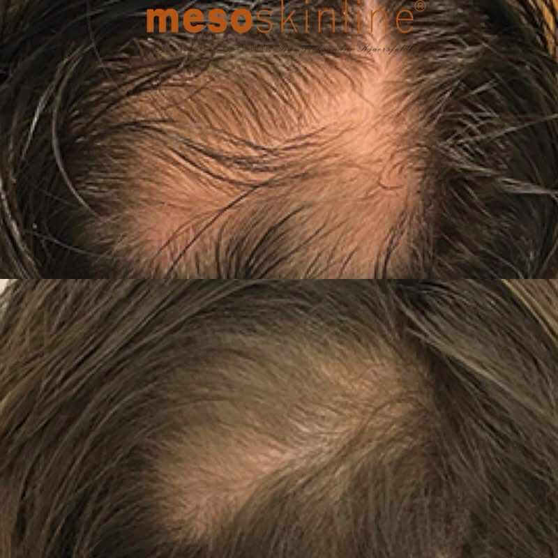 Før og efter Meso Scalp 4
