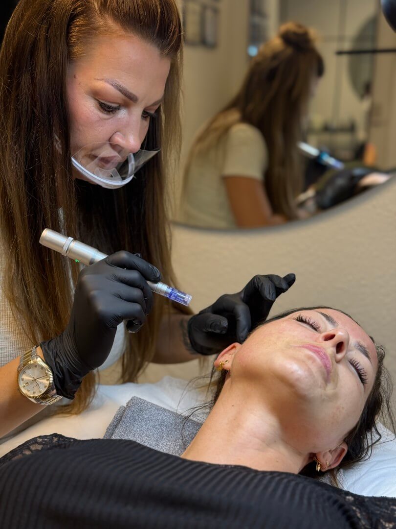Klassisk Microneedling med aktive serummer