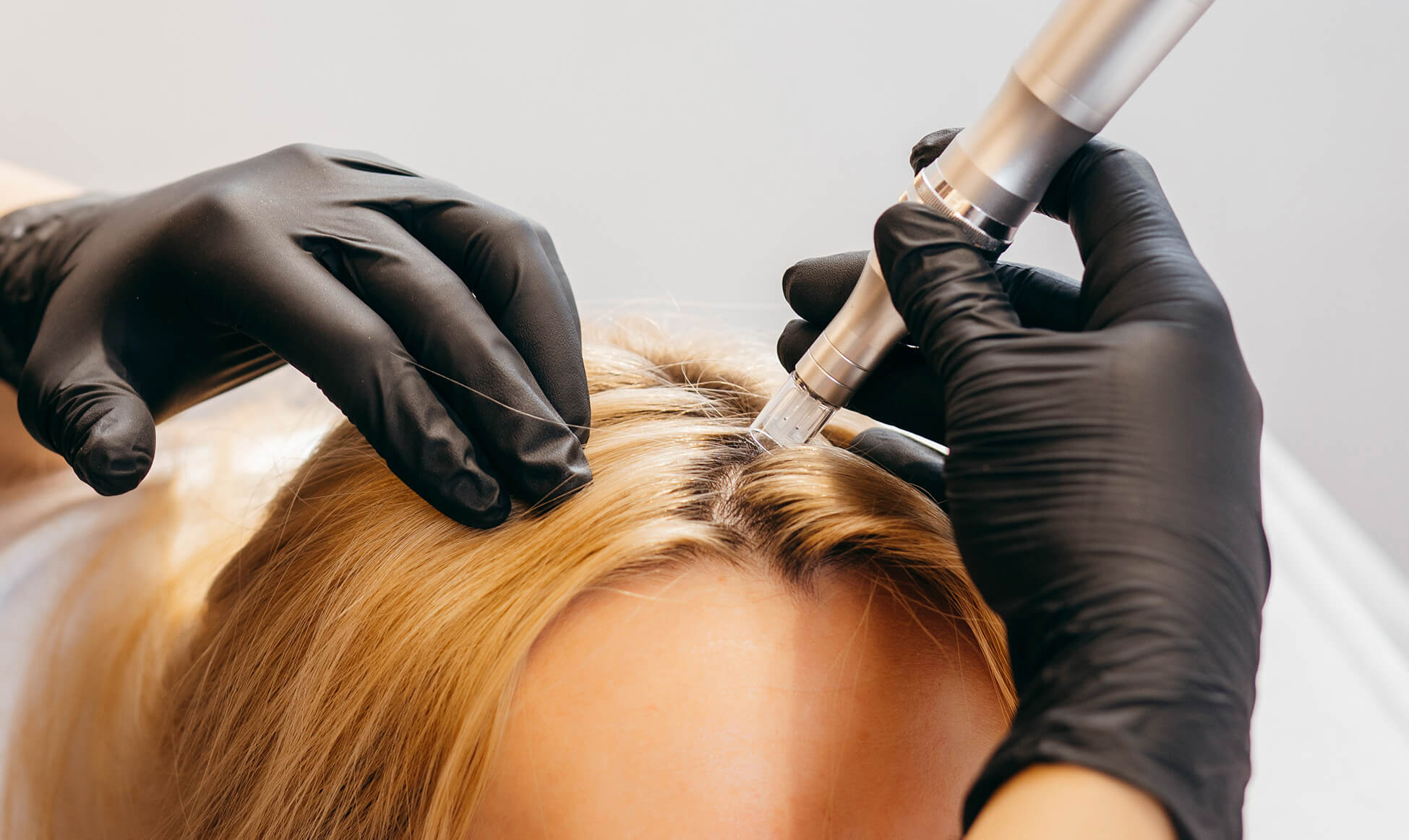 Meso Scalp behandling — MSB