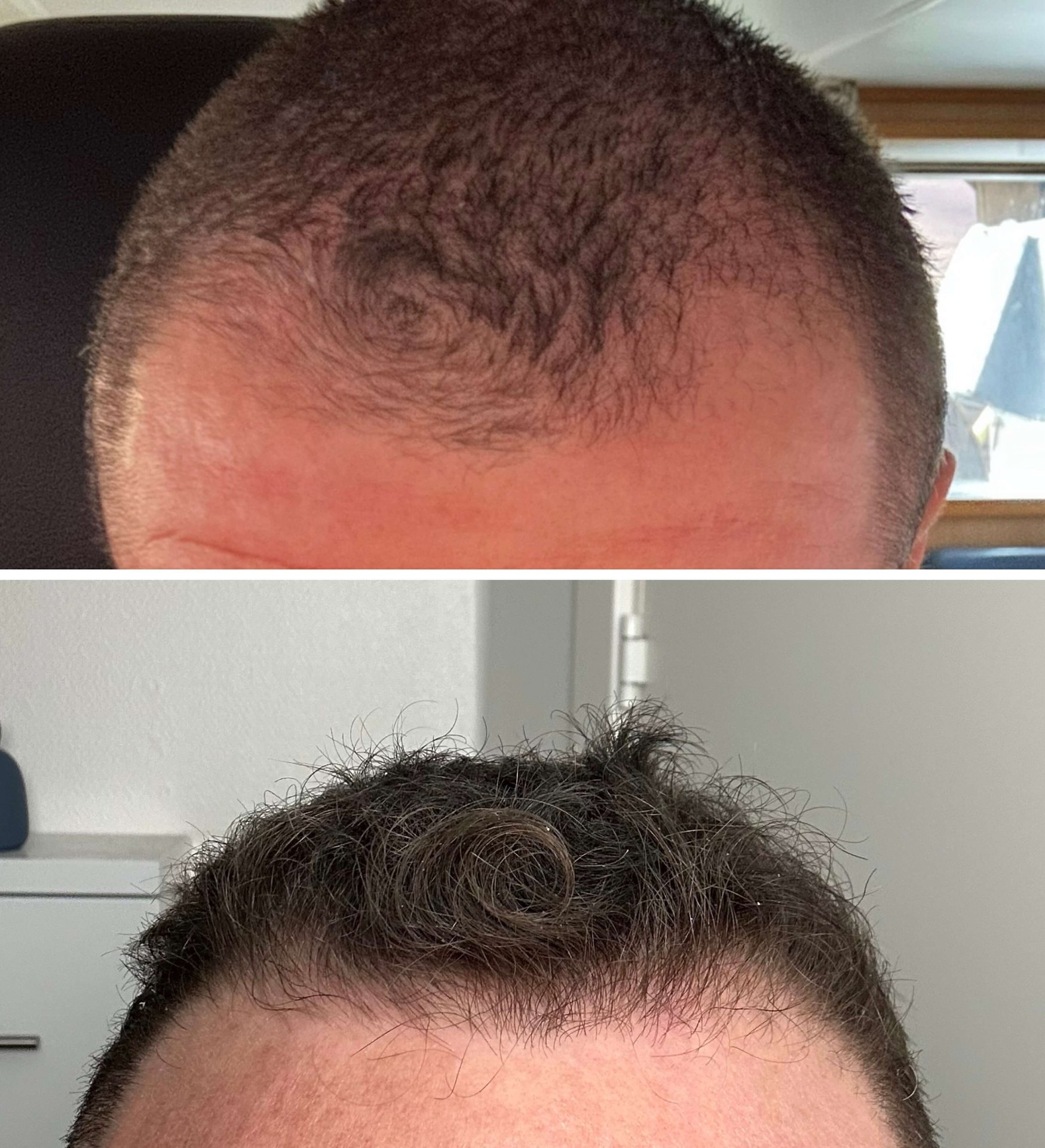 Før og efter MESO SCALP behandling