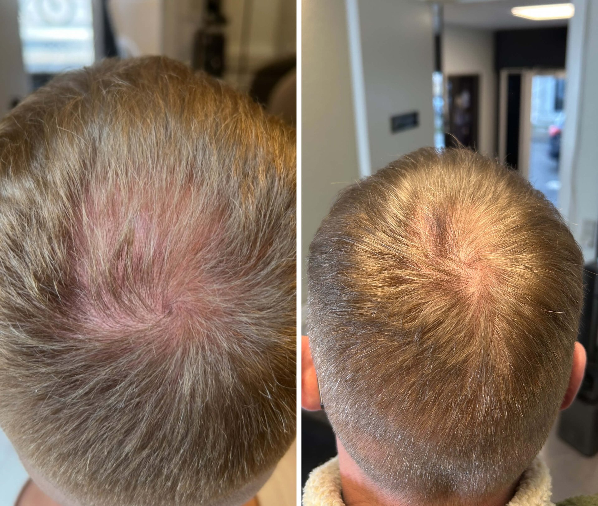 Før og efter Meso Scalp 3